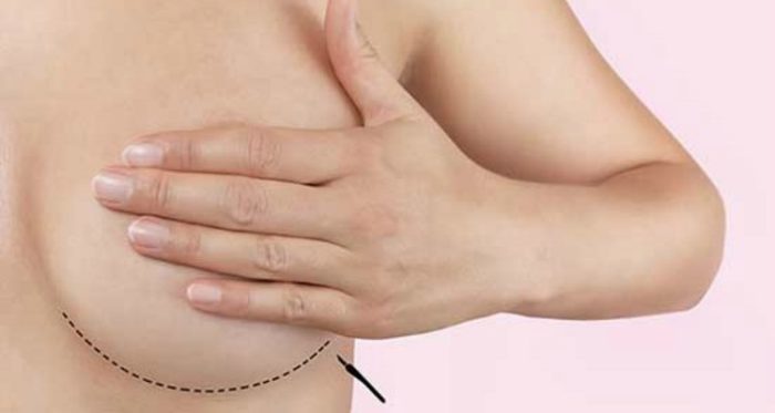 mastectomia-preventiva